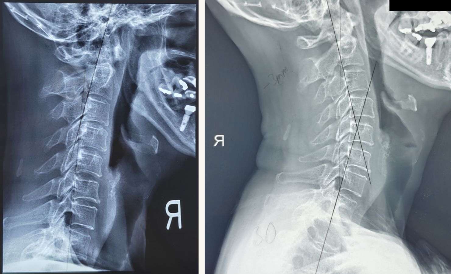 Two side-view neck X-rays of the same patient: before, the curve bends the wrong way; after 24 sessions, a restored forward curve